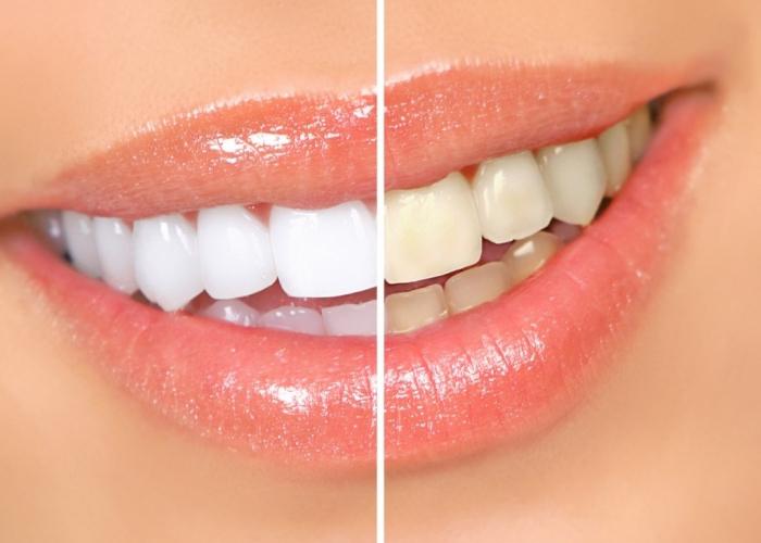 हाइड्रोजन पेरोक्साइड दांत whitening नुस्खा